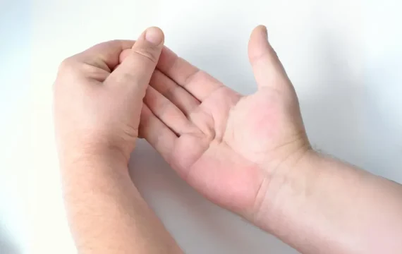 What is Dupuytren's Syndrome