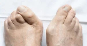 Shockwave Therapy for Hammer Toes