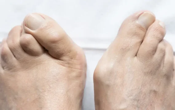 Shockwave Therapy for Hammer Toes