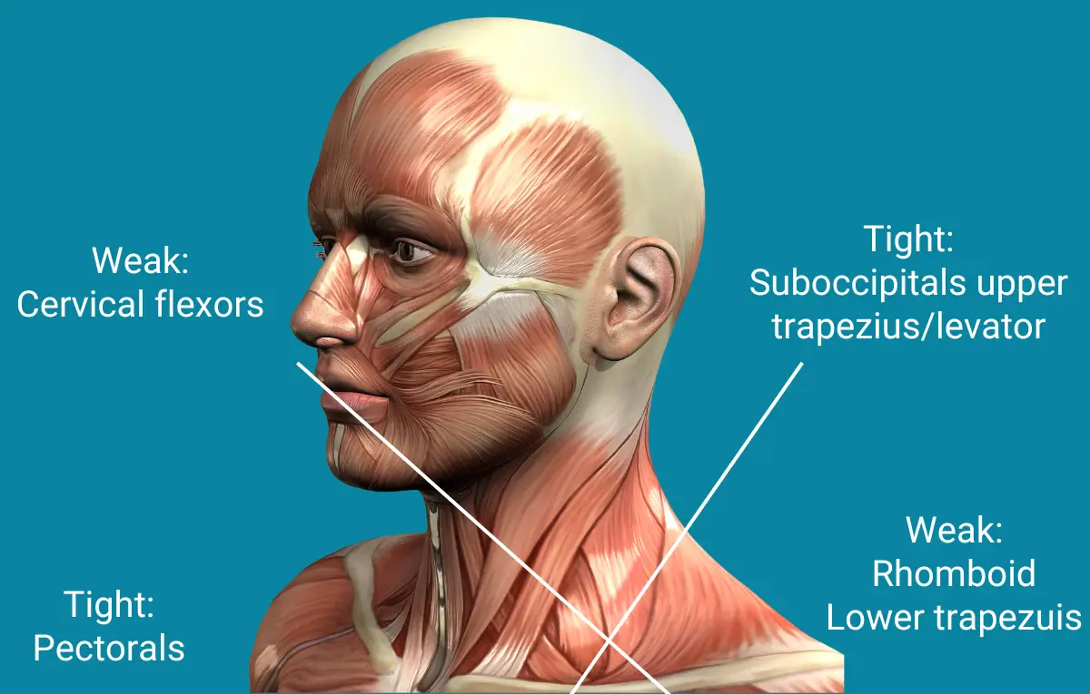 effects of poor posture