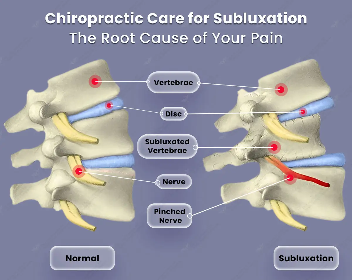 Chiropractic Care for Subluxation